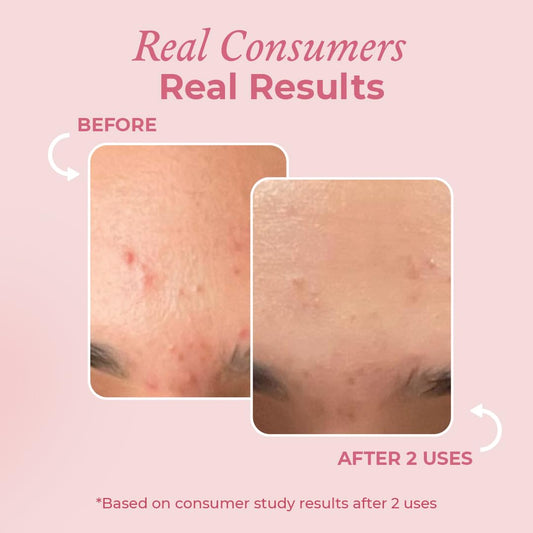 Acne Spot Corrector - 15 ML ( All Skin Types )