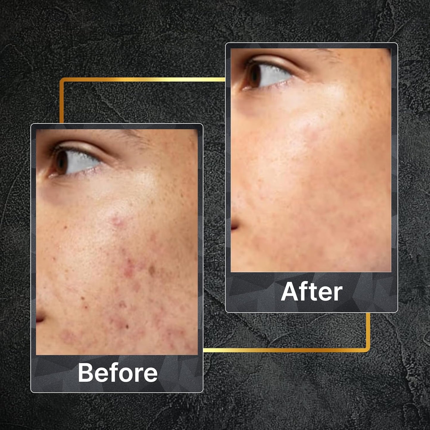 Tru Hair & Skin Nanotechnology Facewash with 2% Salicylic Acid and Tea Tree-100ml